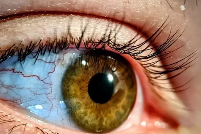 Mata Merah? Ini Cara Aman Mengobatinya di Rumah